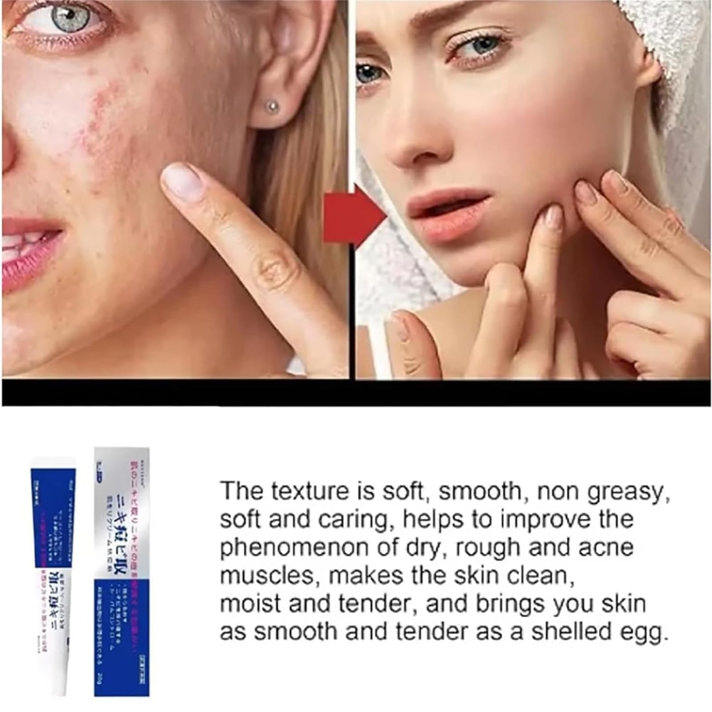 Lion Pair Acne Cream 14g